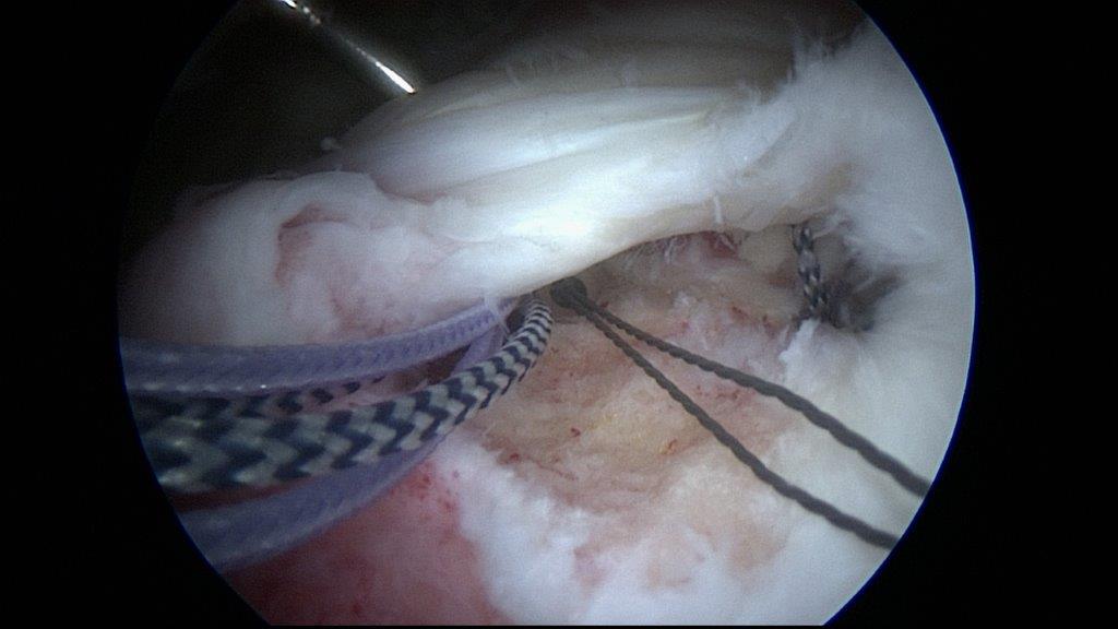 Bild arthroskopisches Nähen