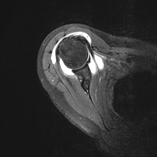 Bild Infraspinatus und Subscapularis intakt