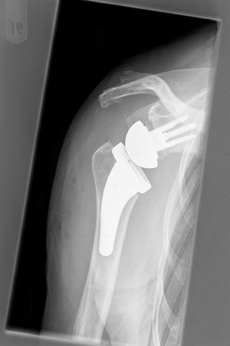 Bild Kurzschaftendoprothese mit Defektaufbau Glenoid