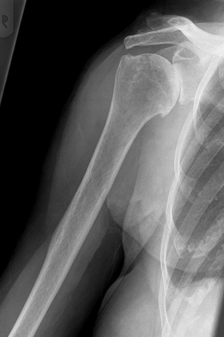 Bild Omarthrose mit Glenoidaufbrauch obere Hälfte