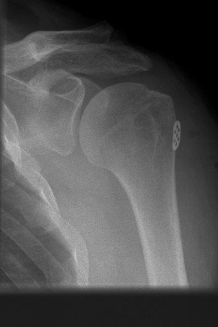 Bild Rotatorenmanschette Auszugsnähte Fixation Plättchen