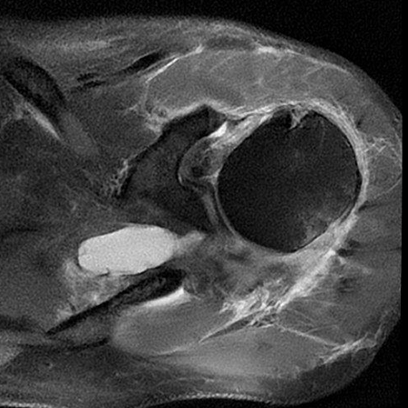 Bild Rotatorenmanschette Subscapularis und Infraspinatus Abriss
