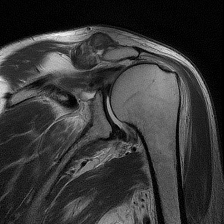 Bild Rotatorenmanschette Supraspinatusabriss
