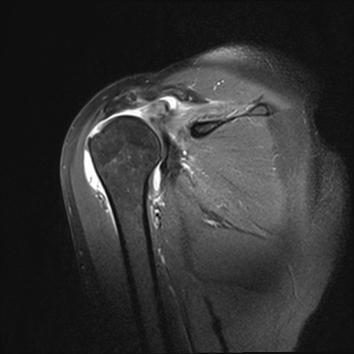 Bild Supraspinatusdefekt