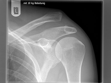 Bild von Schultereckgelenkssprengung