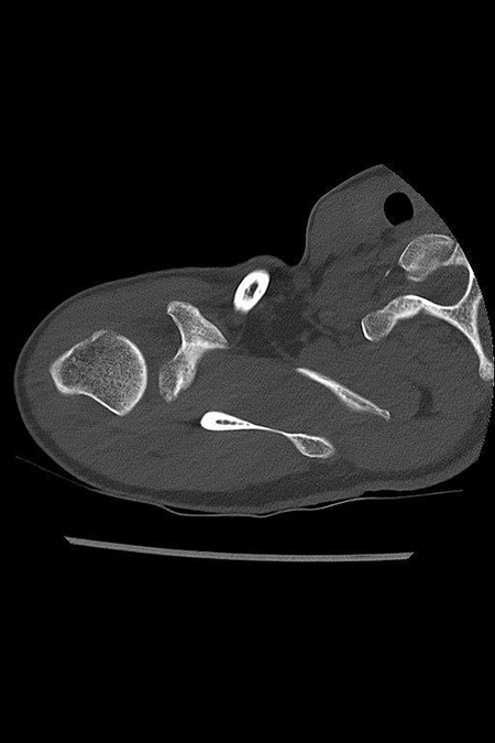 Bild Dorsaler Oberarmkopfdefekt bei Schulterinstabilität