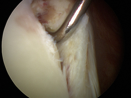 Bild Kapsel Labrumabriss