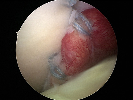 Bild Kapselstabilisation Arthroskopisch