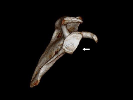 Bild knöcherner Defekt am unteren Pfannenrand