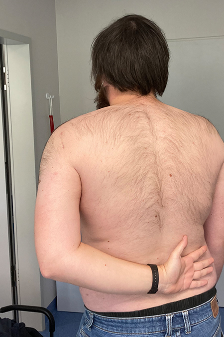 Bild postoperativ Schulterinstabilität Dorsal Knöchern Ergebnis