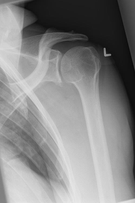 Bild präoperativ Schulterinstabilität Dorsal Knöchern