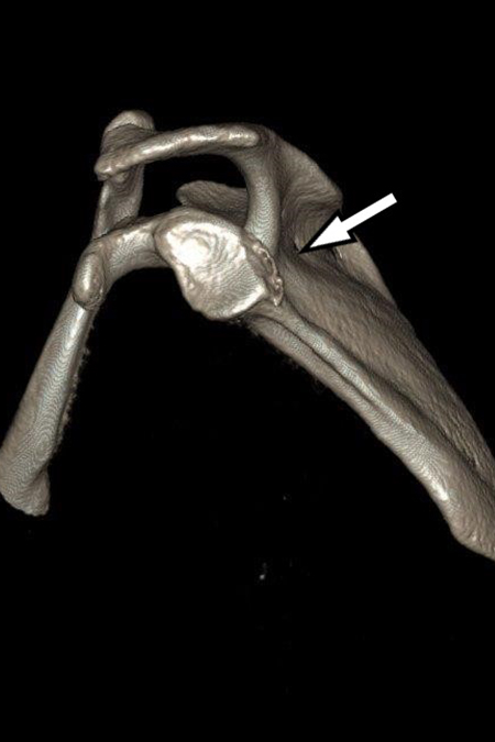 Bild präoperativ Schulterinstabilität Dorsal Knöchern