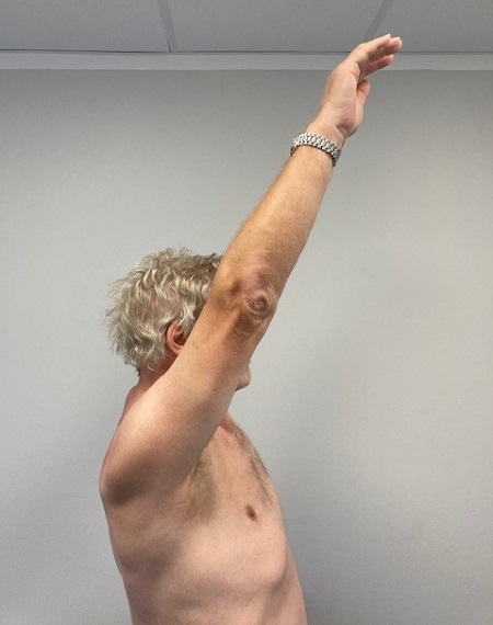 Bild Schulterluxation Patient nach der OP