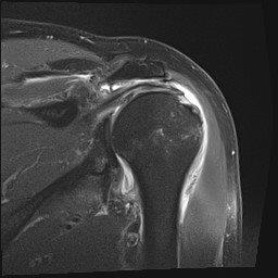 Bild Schulterluxation vor der OP