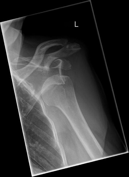 Bild Schulterluxation vor der OP