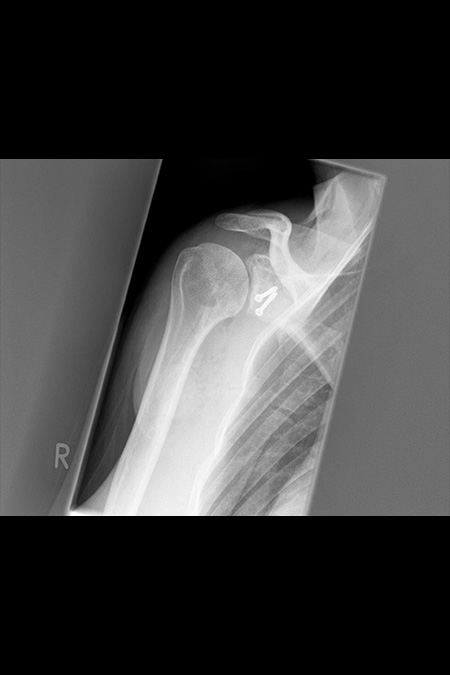 Bild Verschraubung des Rabenschnabels Larjet Operation