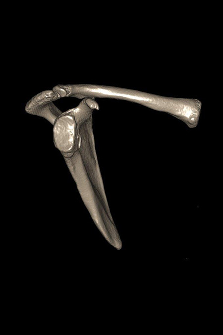 Bild voderer unterer Pfannendefekt vor OP