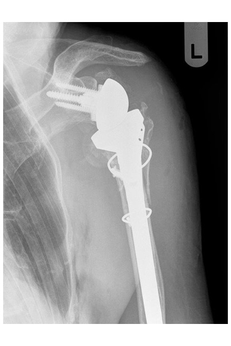 Bild Schulter links nach OP