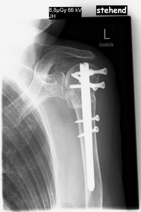 Bild von Nagelosteosynthese stehend